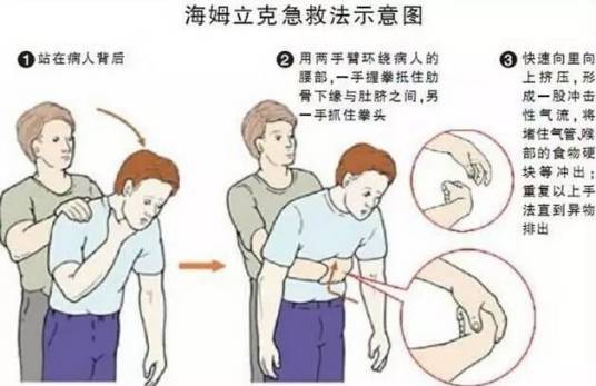 海姆立克的拥抱