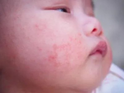 新生儿泪囊炎能自愈吗 3方法应对新生儿泪囊炎