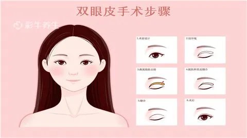 埋线双眼皮多久恢复自然呢