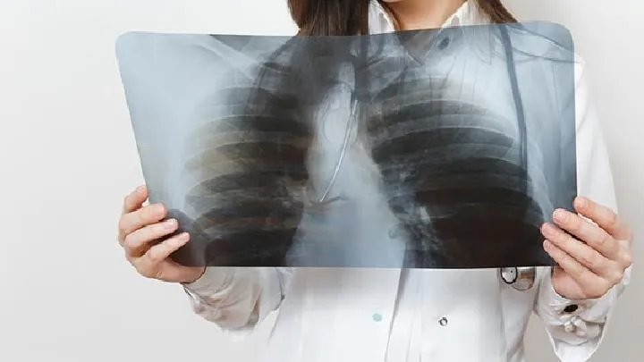 治疗肺纤维化偏方有哪些