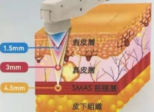 热玛吉危害?热玛吉三天后脸起皮,红肿,医生建议吃修复营养ACMETEA修复受损细胞,吃了一个月,效