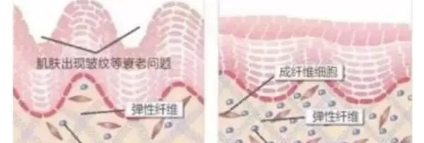热玛吉危害?热玛吉三天后脸起皮,红肿,医生建议吃修复营养ACMETEA修复受损细胞,吃了一个月,效