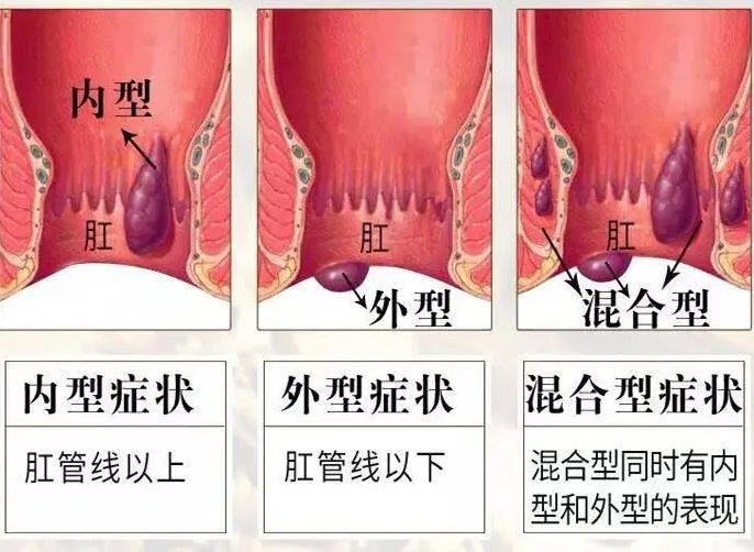 关于痔疮的一些常识
