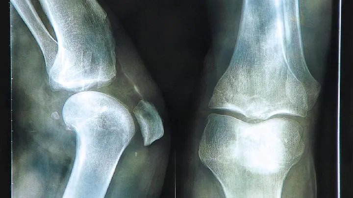 关于股骨头坏死的一些介绍