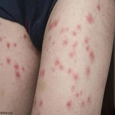 大腿肚内侧红疙瘩如何改善