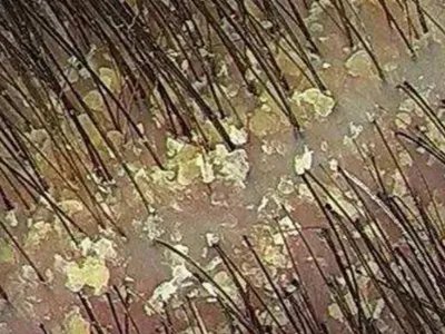 皮脂溢出头皮脱屑图片