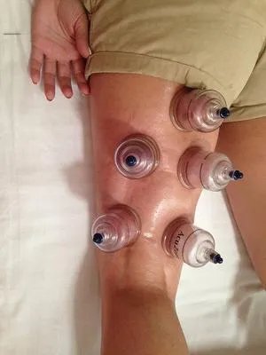 拔火罐的注意事项及禁忌症