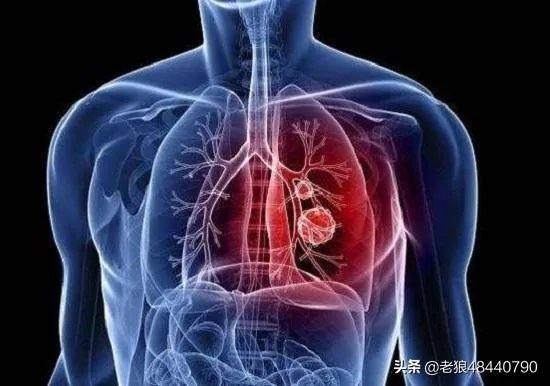 从华盛顿州宣布紧急状态看,可能全美爆发,美国有无财力去控制疫情?
