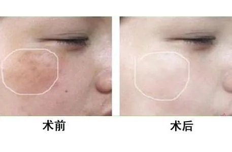 彩光嫩肤祛斑价格是多少