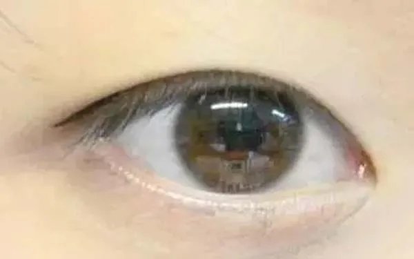 北京开眼角哪个医院好?
