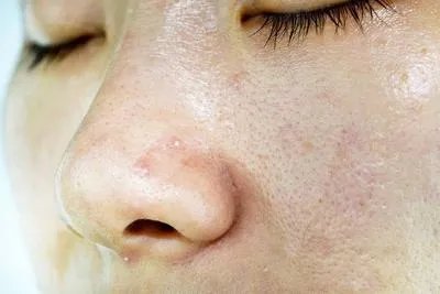 治疗黑头最有效的方法