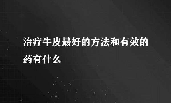 治疗牛皮最好的方法和有效的药有什么