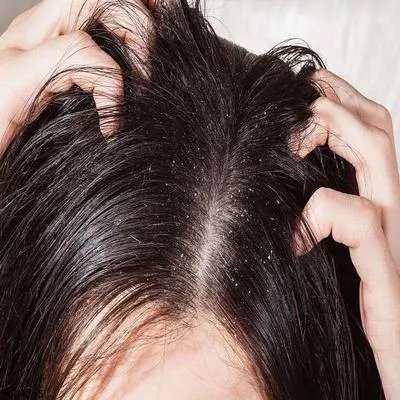 头部牛皮癣有什么好的治疗方法