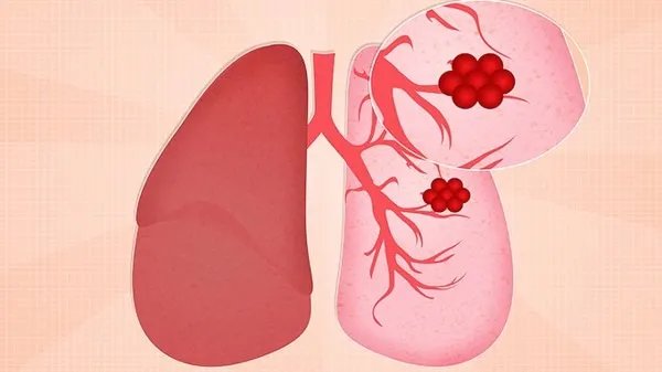 70岁肺癌晚期能活多久？肺癌临死前的15个征兆