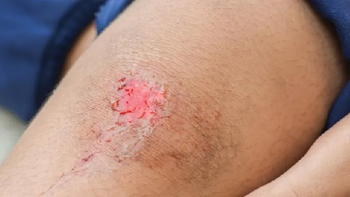疤痕的非手术疗法