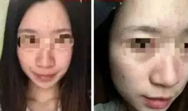 热玛吉危害?热玛吉三天后脸起皮,红肿,医生建议吃修复营养ACMETEA修复受损细胞,吃了一个月,效