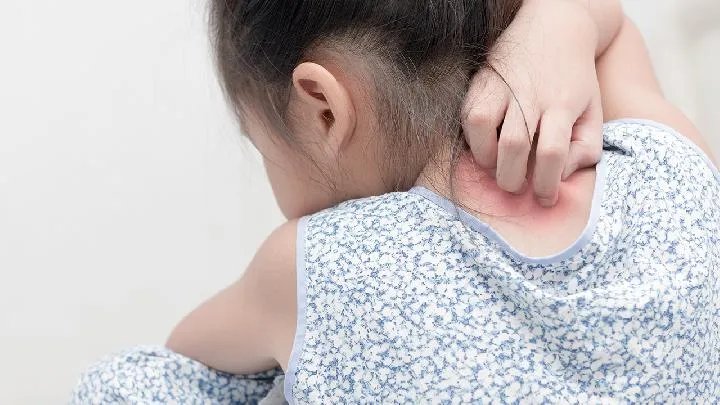 人工荨麻疹治疗偏方