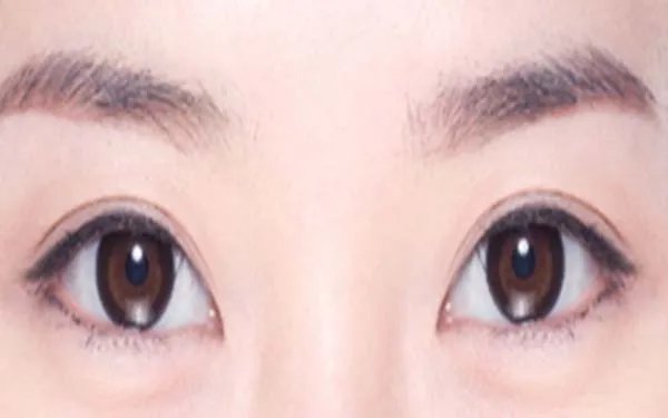 北京开眼角哪个医院好?