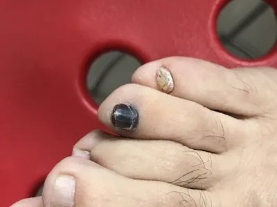 肢端雀斑痣样黑素瘤黑斑图片