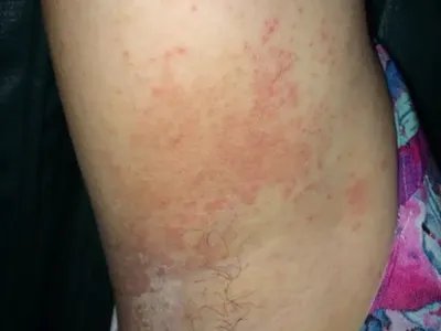 间擦疹丘疹图片