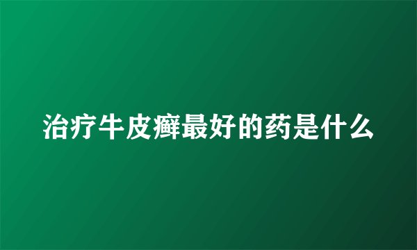 治疗牛皮癣最好的药是什么