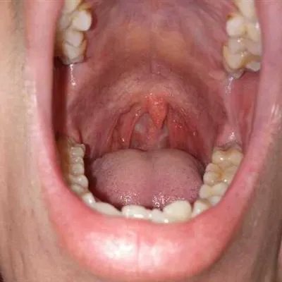 过敏性咽炎应该怎么治疗?