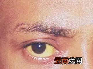 金瞳是什么？