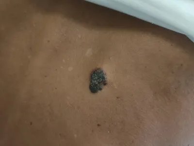 肢端雀斑痣样黑素瘤黑斑图片