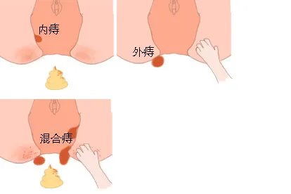 女性痔疮分类真实症状图片