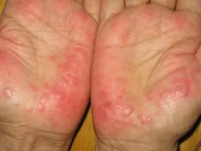 急性发热性嗜中性皮病手掌症状图片