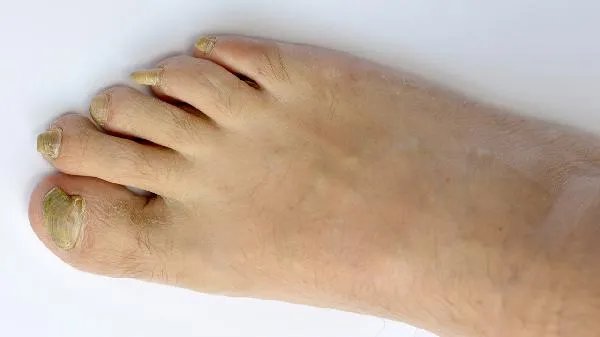 甲沟炎红色息肉能自然脱落吗