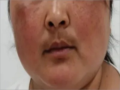 库欣综合征肥胖图片